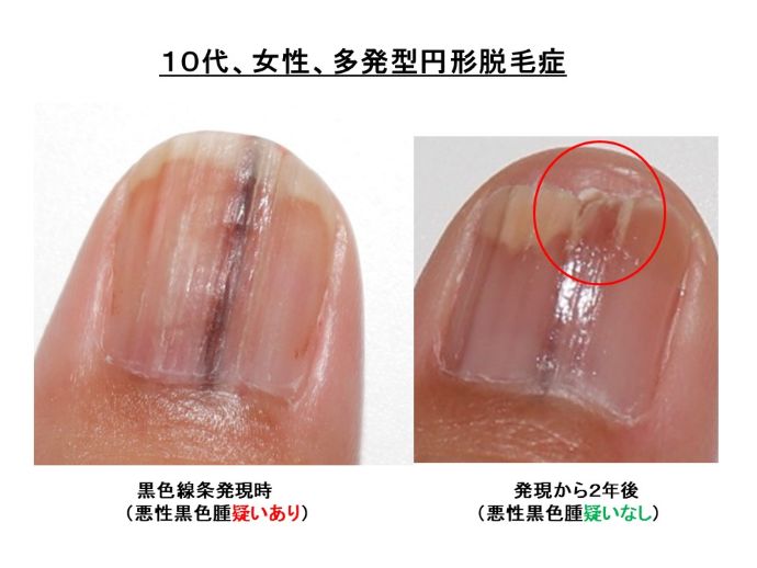 円形脱毛症　病院